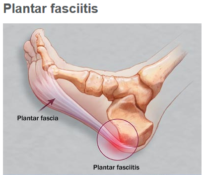 dealing with plantar fasciitis pain